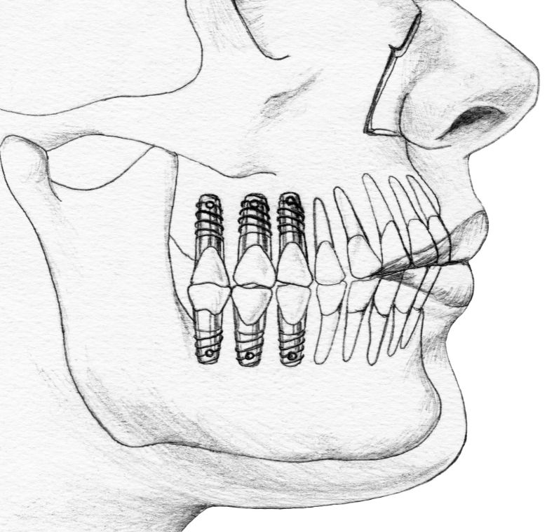 imagen de implantes dentales carga inmediata clinica arco chamberi madrid