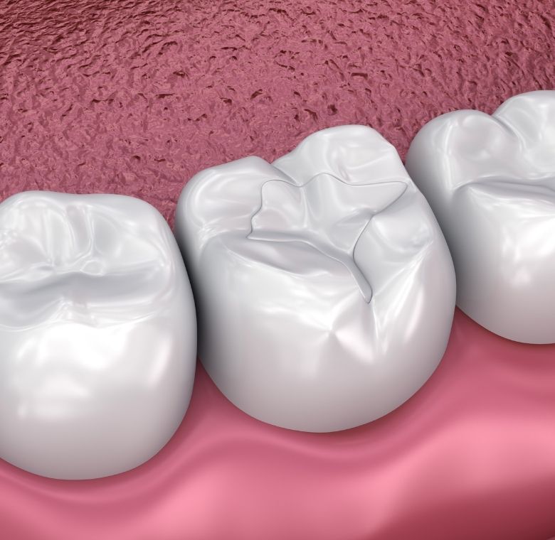 imagen de empastes dentales en chamberi clinica arco madrid